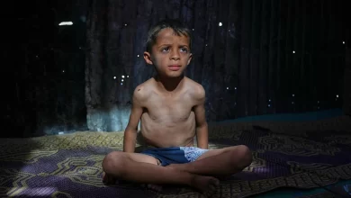 Child Malnutrition in Gaza