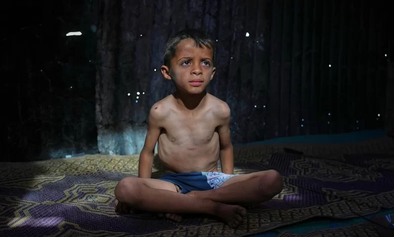 Child Malnutrition in Gaza